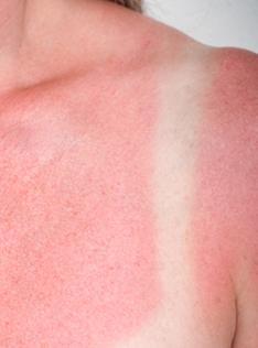 Was ist ein Sonnenbrand?